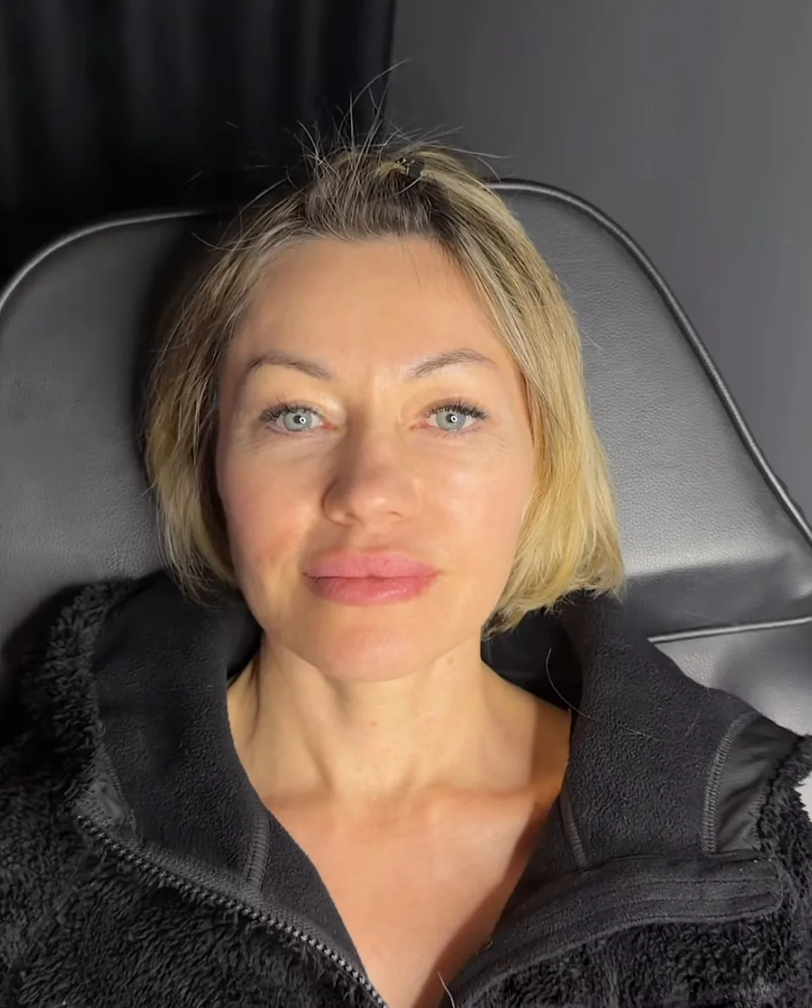 Full face гармонізація обличчя в AK Cosmetology